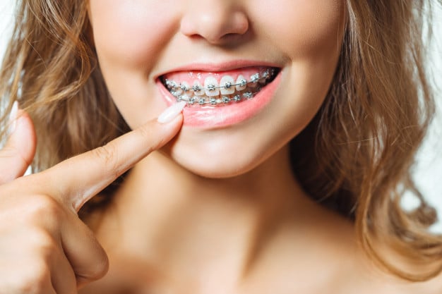 Best Dental Braces Treatment in Ahmedabad