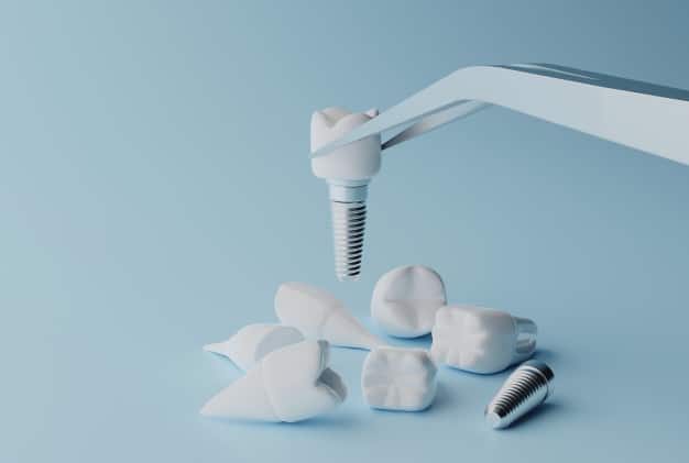 dental implant in ahmedabad