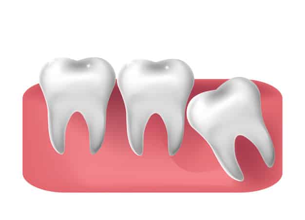 painless wisdom tooth removal in Ahmedabad