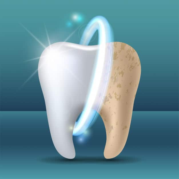 Teeth Whitening treatment