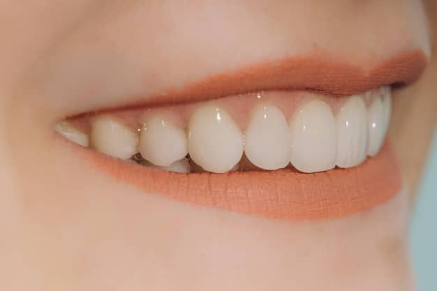 dental veneers in ahmedabad