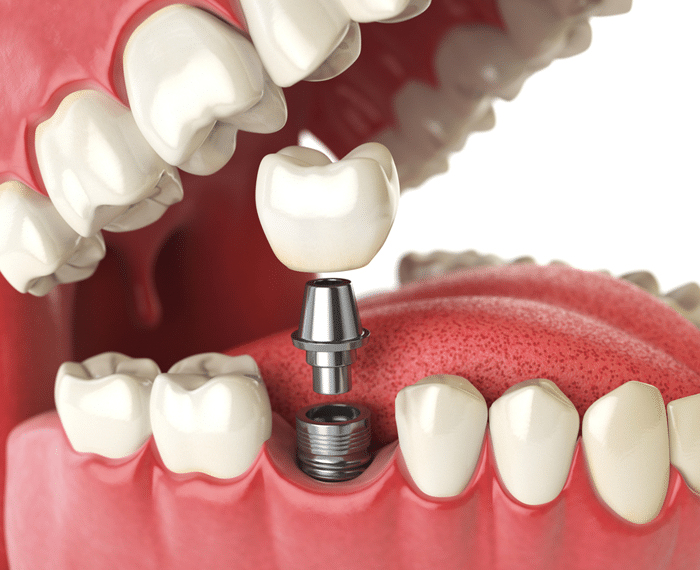 best dental implantologist treatment