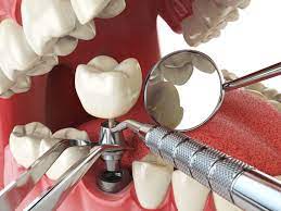 emergency dental implant